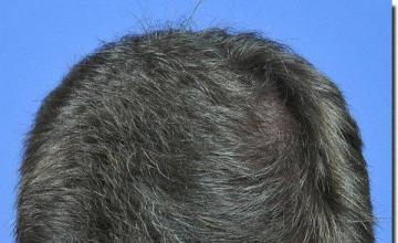 Hair restoration procedure results