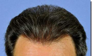 Hair restoration procedure results