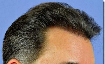 Hair restoration procedure results