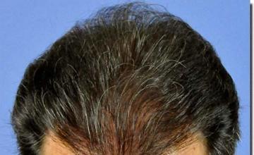 Hair restoration procedure results