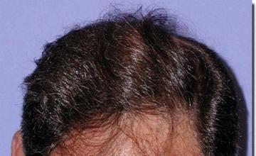 Hair restoration procedure results