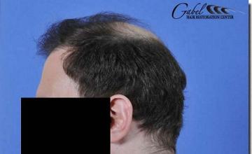 Hair restoration procedure results