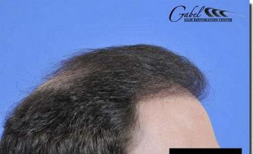 Hair restoration procedure results