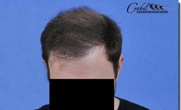 Hair restoration procedure results