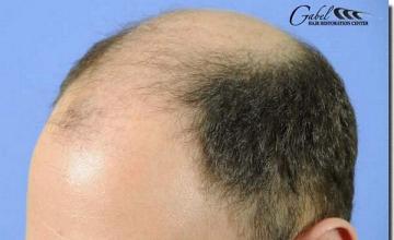 Hair restoration procedure results