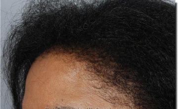 Hair restoration procedure results