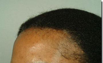 Hair restoration procedure results