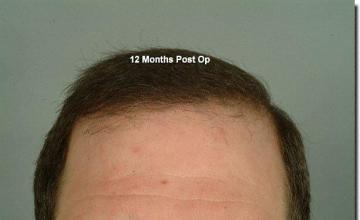 Hair restoration procedure results