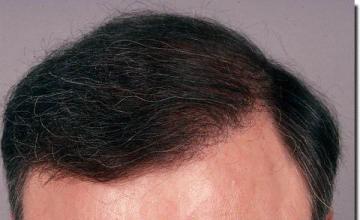 Hair restoration procedure results