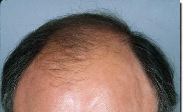 Hair restoration procedure results