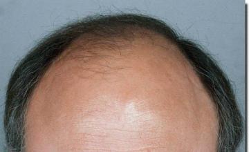 Hair restoration procedure results