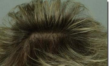 Hair restoration procedure results