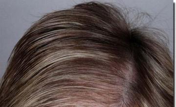 Hair restoration procedure results