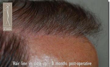 Hair restoration procedure results