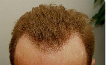 Hair restoration procedure results