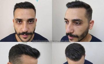 Hair restoration surgery after photos