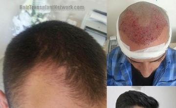 Hair transplantation surgery before and after photos