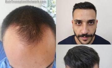 Hair transplantation surgery before and after pictures