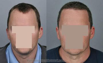 Front view - Before and after