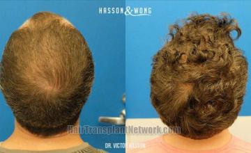 Hair restoration procedure before and after pictures