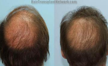 Hair replacement surgery before and after images