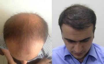 Hair restoration procedure before and after pictures