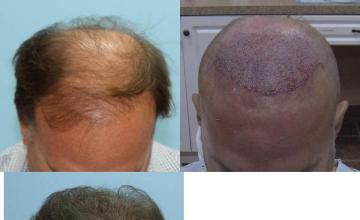 Top view before and after hair restoration results