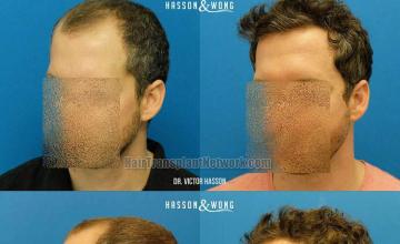 Hair transplantation surgery before and after pictures