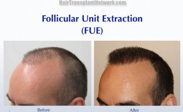 Hair transplantation surgery before and after pictures