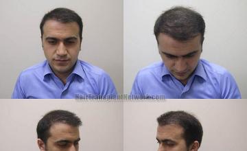 Hair restoration procedure before and after result photographs