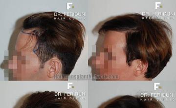 Hair transplantation surgery before and after images