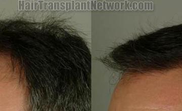 Hair restoration procedure results