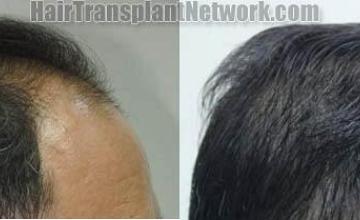 Hair transplantation surgery before and after images