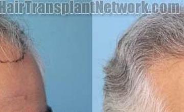 Hair transplantation surgery before and after photos