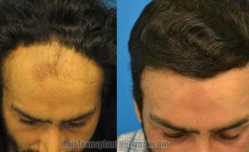 Hair transplantation surgery before and after photos