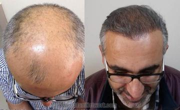 Hair restoration surgery before and after images