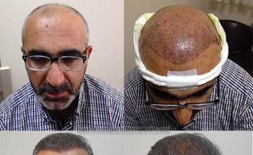 Hair restoration procedure before and after results