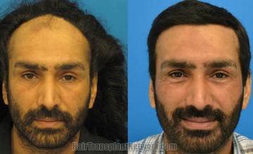 Hair restoration procedure before and after results