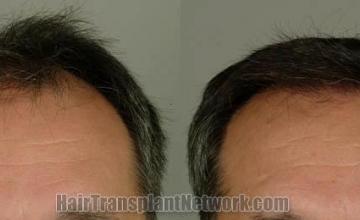 Hair restoration procedure before and after results