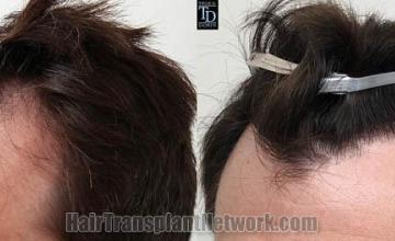 Hair transplantation surgery before and after images