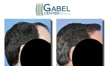 Hair transplantation surgery before and after images