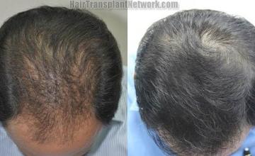 Hair transplantation surgery before and after photos