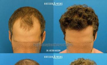 Hair transplantation surgery before and after photos