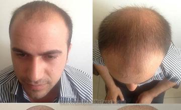 Hair restoration procedure before and after result photographs