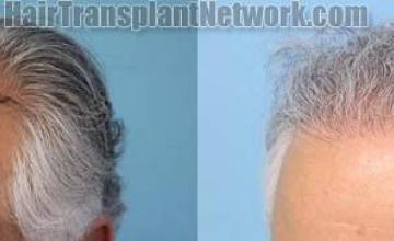 Hair transplantation surgery before and after images