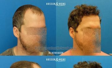 Hair transplantation surgery before and after images