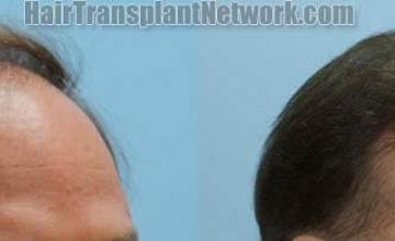  before and after images