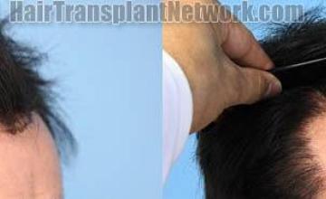 Hair transplantation surgery before and after images