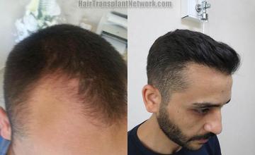 Hair transplantation surgery before and after photos