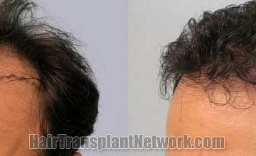 Hair transplantation surgery before and after pictures